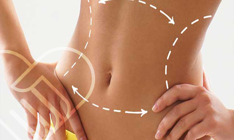 راهکارهایی برای کاهش ورم بعد از لیپوماتیک