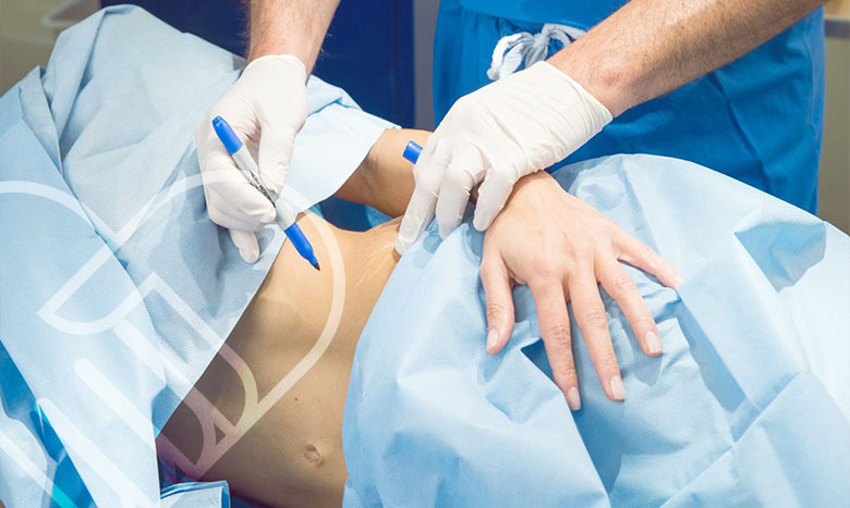 عمل لیپوماتیک چگونه انجام میشود؟