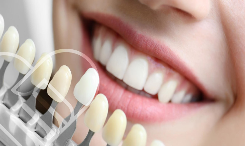 فواید استفاده از لمینت دندان فوری