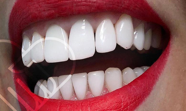 لمینت کامپوزیتی
