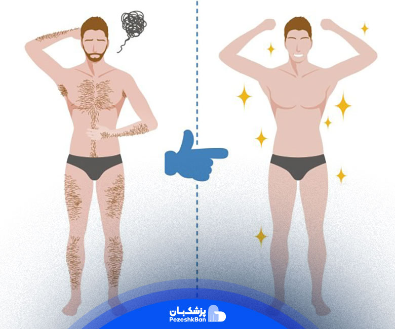 مناطق مورد نظر برای لیزر موهای زائد بدن در آقایان