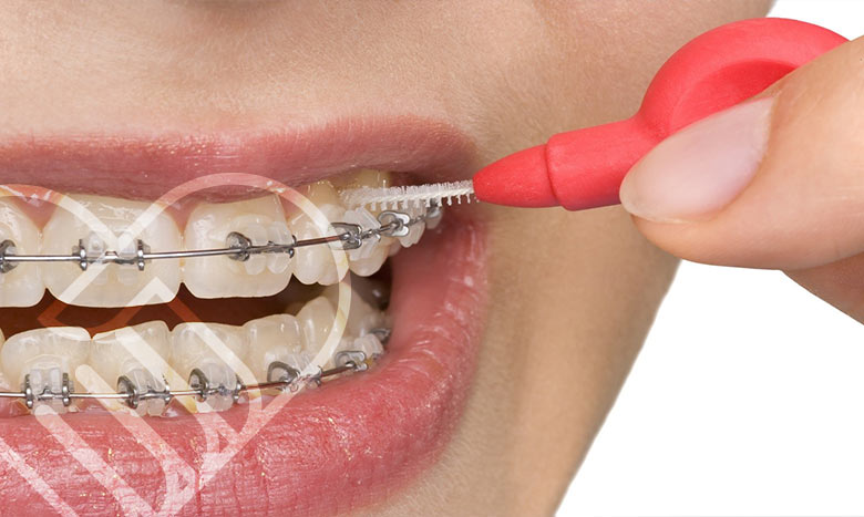 مراحل ارتودنسی نامرئی چیه؟