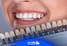 انواع لمینت دندان