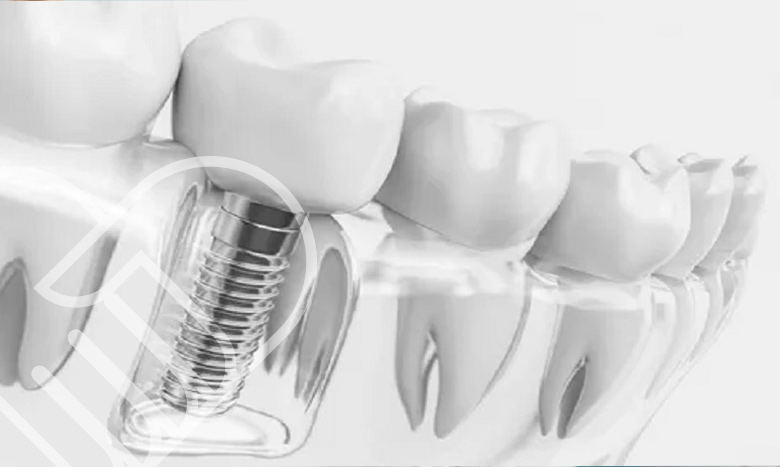 پروسه ایمپلنت دندان