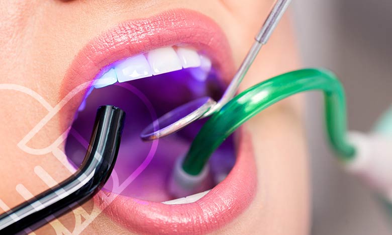 چگونه عوارض کامپوزیت دندان را کاهش دهیم؟