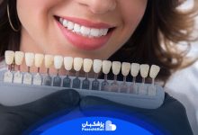 کامپوزیت دندان چیست؟