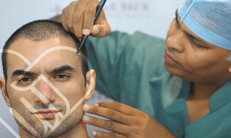 چگونه از موی کاشته شده مراقبت کنیم؟
