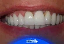 ایمپلنت دندان جلو + مدت زمان و نحوه انجام و قیمت