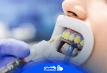 بلیچینگ دندان چیست و هزینه انجام آن چقدر است؟