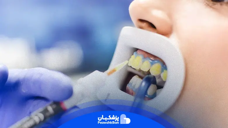 بلیچینگ دندان چیست و هزینه انجام آن چقدر است؟