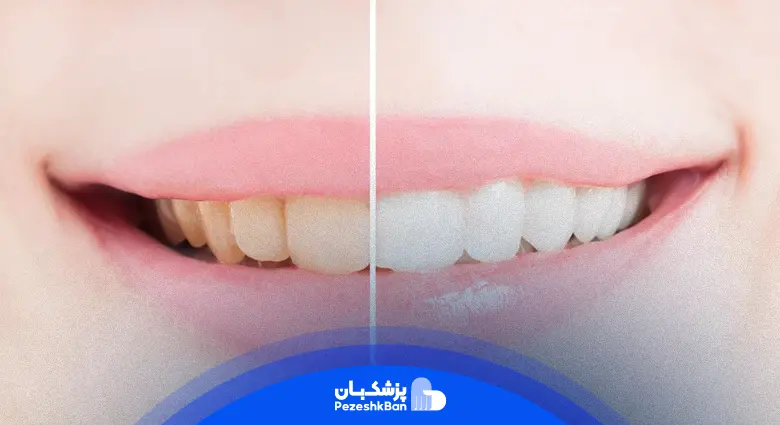 بلیچینگ دندان چقدر دوام دارد | ماندگاری بلیچینگ دندان چقدر است؟