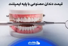 قیمت دندان مصنوعی بر پایه ایمپلنت چقدر است؟