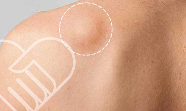 دلیل ابتلا به غده های زیر پوست بدن
