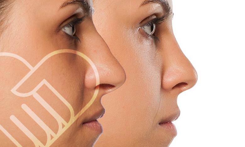 پیشگیری از افتادگی نوک بینی