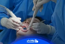 جرم‌گیری دندان | هزینه + روش های خانگی کاربردی