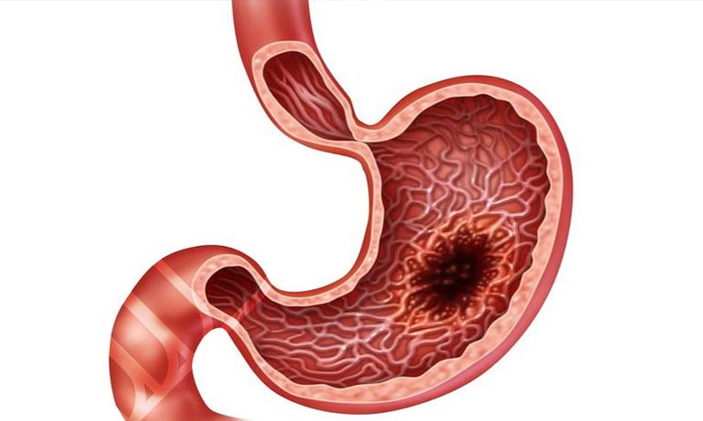 علائم زخم معده در انسان