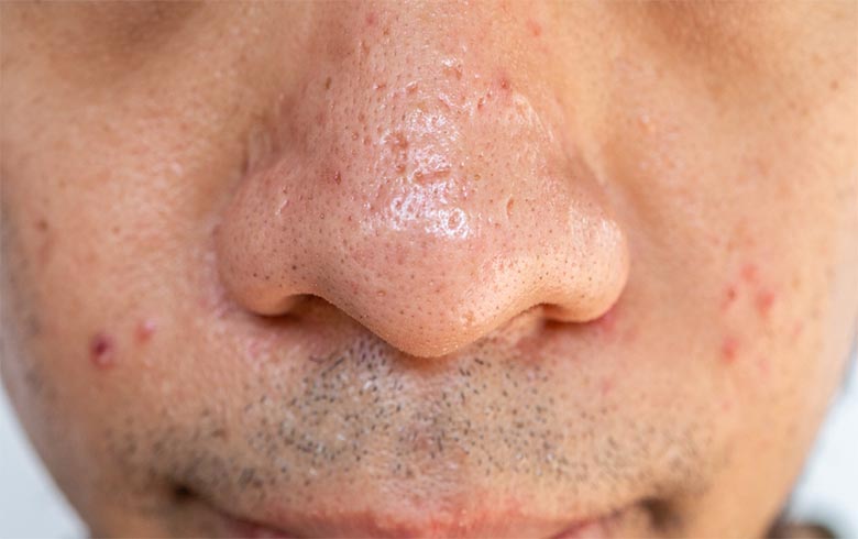علت ورم بینی بعد از عمل + نحوه کاهش آن