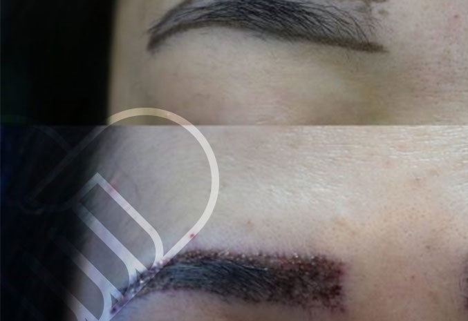 کاشت ابرو نمونه کار