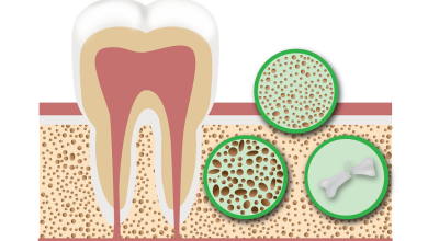 ایمپلنت دندان و پوکی استخوان