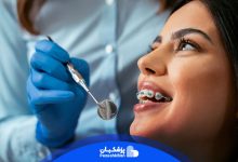 ارتودنسی دندان چیست و چه انواعی دارد؟
