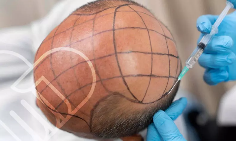 کاشت مو با سلول بنیادی چگونه است؟