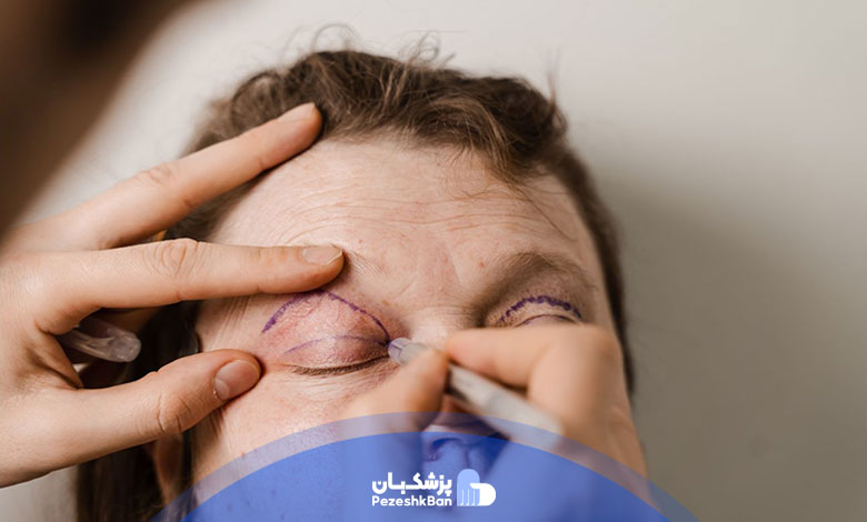 دلایل عدم عدم تقارن پلک بعد از بلفاروپلاستی