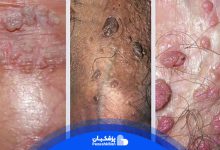 تفاوت زگیل تناسلی با جوش
