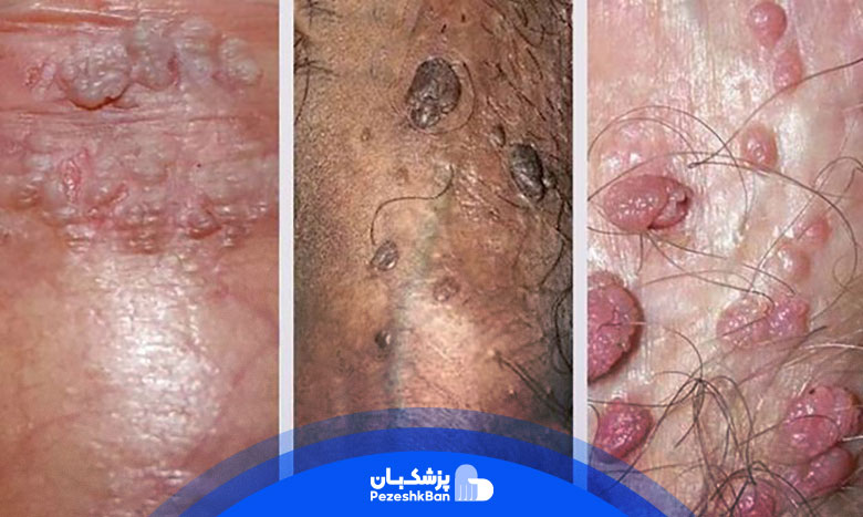 تفاوت زگیل تناسلی با جوش