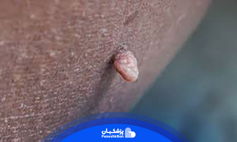 تفاوت های درمانی زگیل تناسلی با جوش