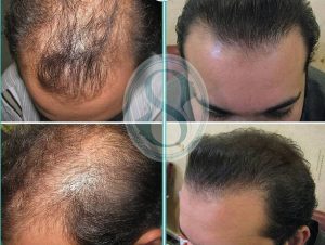 نمونه کار کاشت مو ساعی