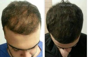 نمونه کار کاشت مو ساعی2