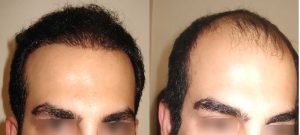 نمونه کار کاشت مو بهترین کلینیک 1