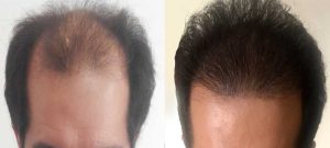 نمونه کار کاشت مو بهترین کلینیک 4