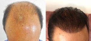 نمونه کار کاشت مو بهترین کلینیک 2
