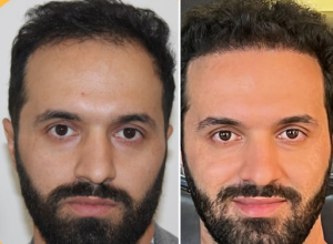 نمونه کار کاشت مو تهران کلینیک2