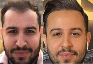 نمونه کار کاشت مو تهران کلینیک1